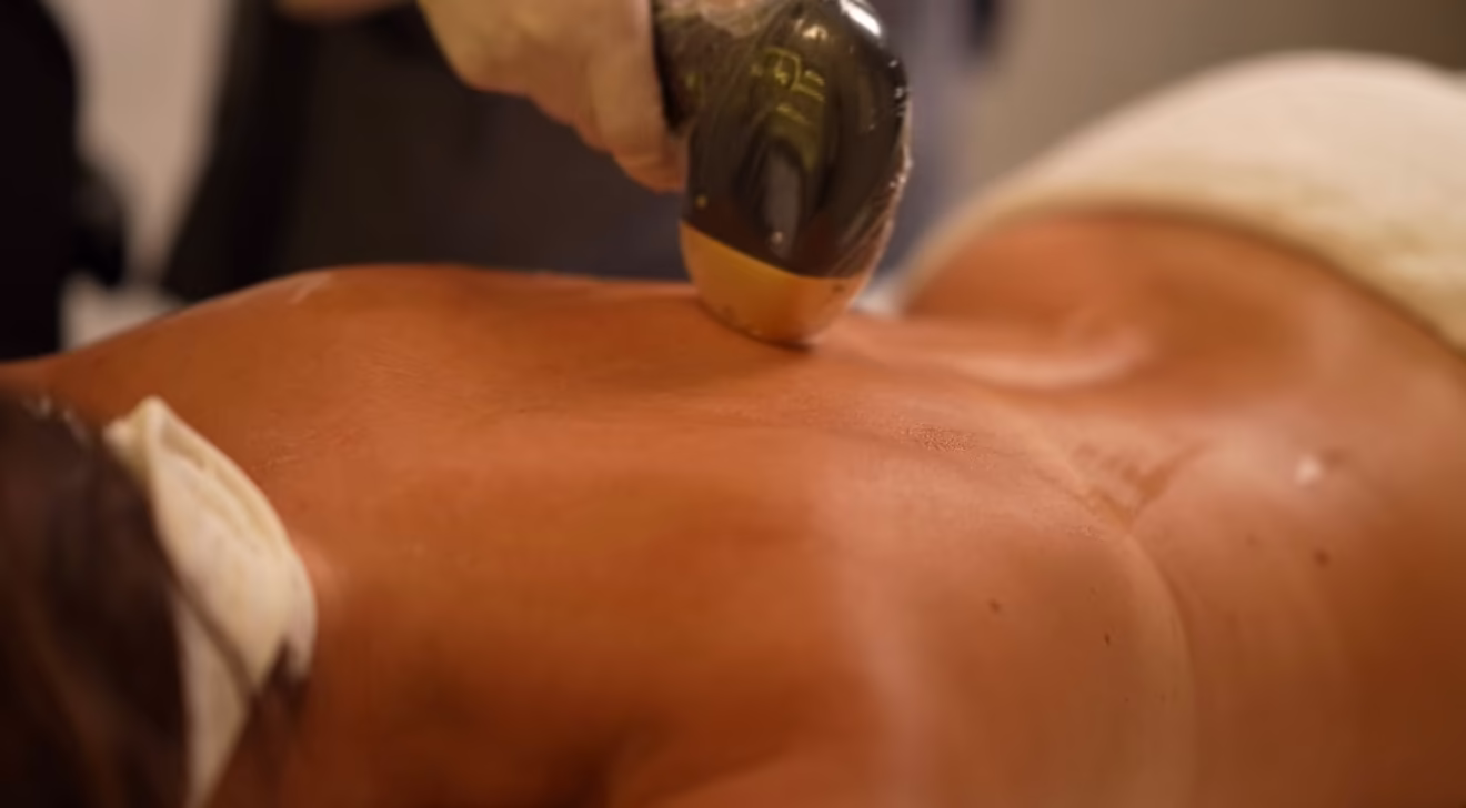 الليزر — الظهر - Fatma Süha Beauty & Skincare Expert - Wellness